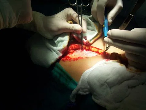 Splenectomy Stock Photos