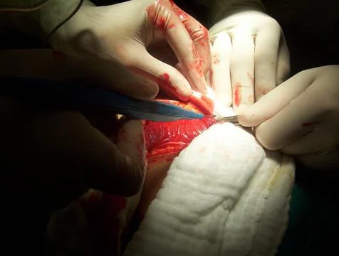 Splenectomy Stock Photos