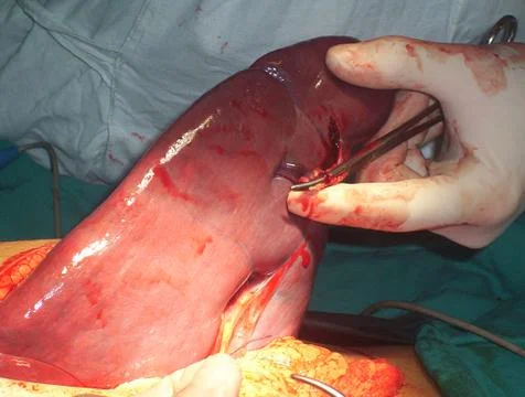 Splenectomy Stock Photos