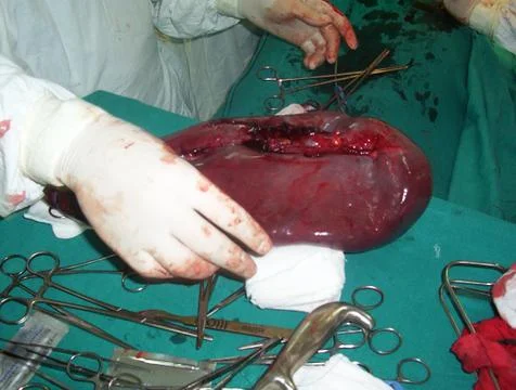 Splenectomy Stock Photos