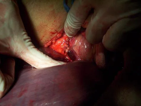 Splenectomy Stock Photos