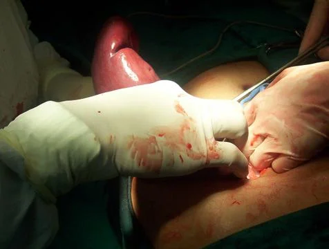 Splenectomy Stock Photos