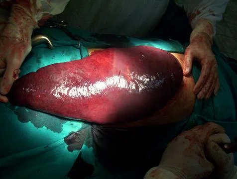 Splenectomy Stock Photos