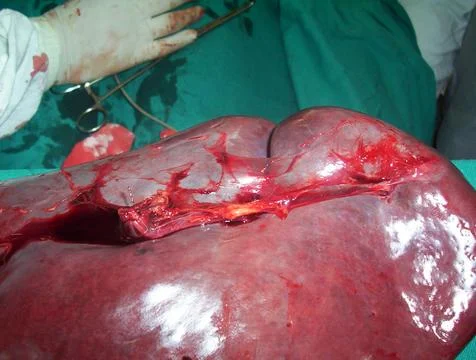 Splenectomy Stock Photos