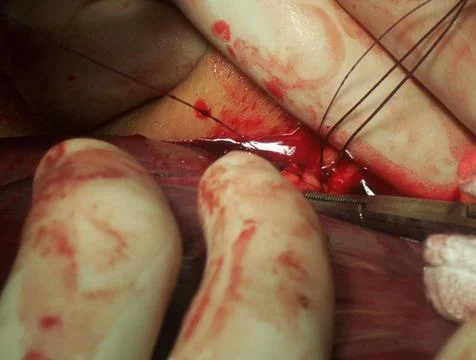 Splenectomy Stock Photos