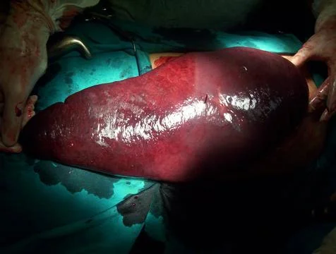 Splenectomy Stock Photos