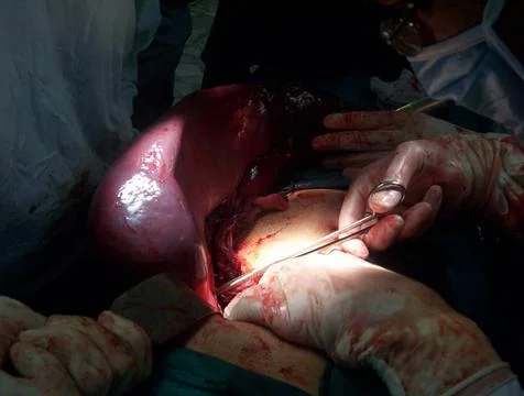 Splenectomy Stock Photos