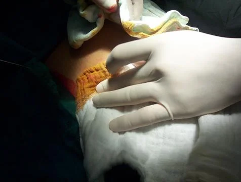 Splenectomy Stock Photos