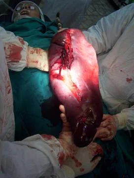 Splenectomy Stock Photos