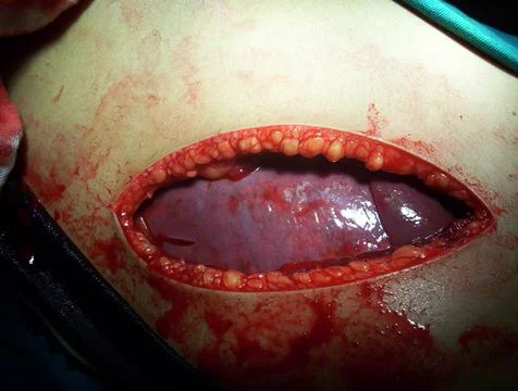 Splenectomy Stock Photos