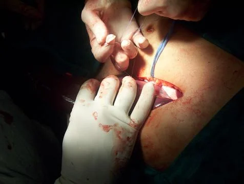 Splenectomy Stock Photos