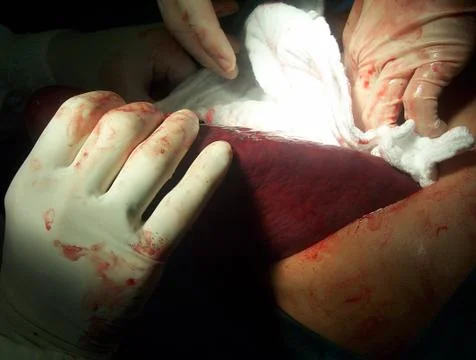 Splenectomy Stock Photos