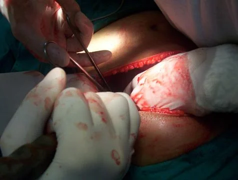 Splenectomy Stock Photos