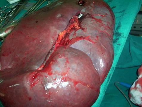 Splenectomy Stock Photos