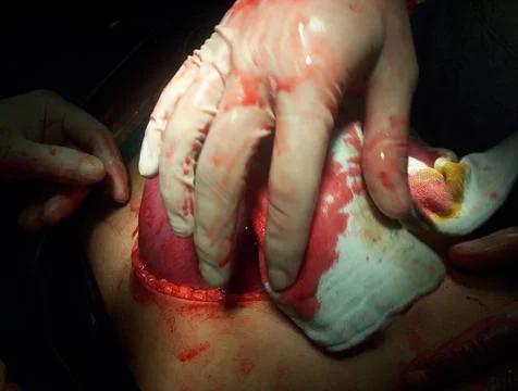 Splenectomy Stock Photos