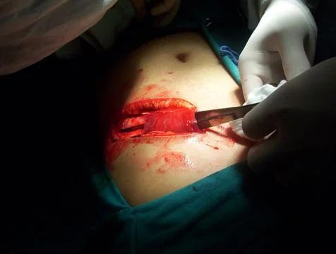 Splenectomy Stock Photos