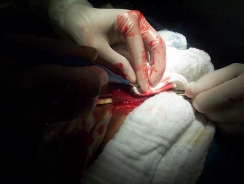 Splenectomy Stock Photos