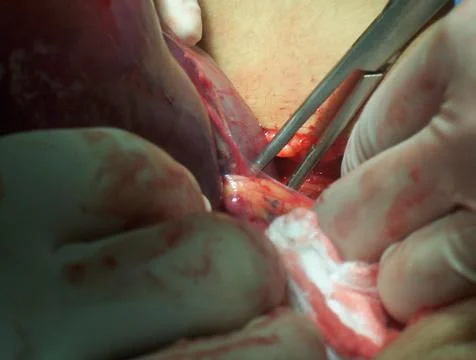 Splenectomy Stock Photos