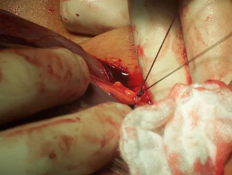 Splenectomy Stock Photos