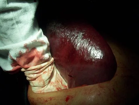 Splenectomy Stock Photos