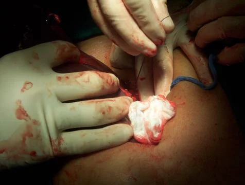 Splenectomy Stock Photos
