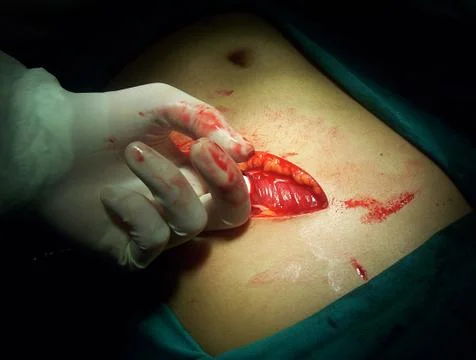 Splenectomy Stock Photos