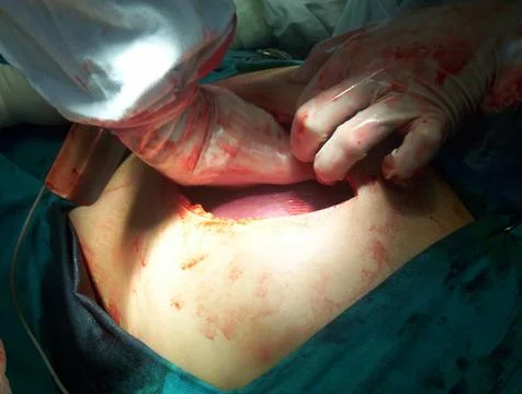 Splenectomy Stock Photos