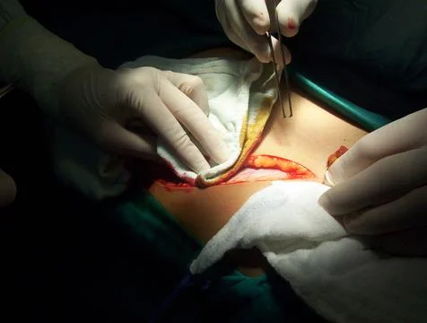 Splenectomy Stock Photos