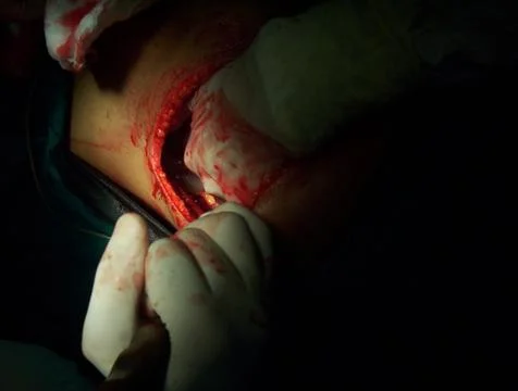 Splenectomy Stock Photos