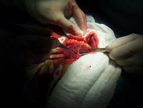 Splenectomy Stock Photos