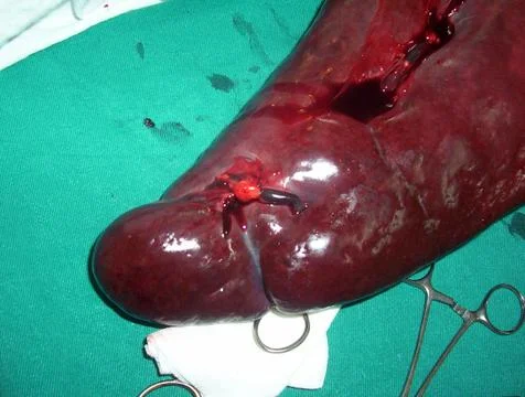 Splenectomy Stock Photos