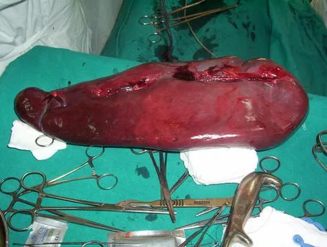 Splenectomy Stock Photos