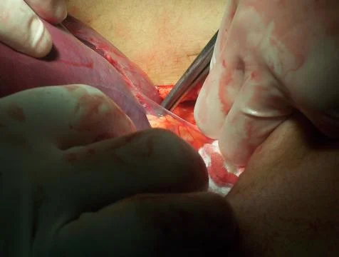 Splenectomy Stock Photos