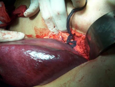 Splenectomy Stock Photos