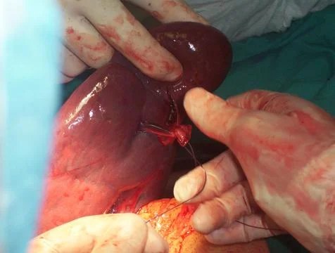Splenectomy Stock Photos