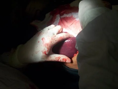 Splenectomy Stock Photos