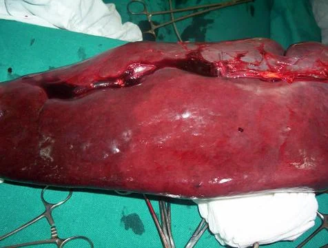 Splenectomy Stock Photos