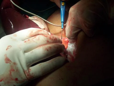 Splenectomy Stock Photos