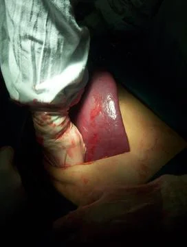 Splenectomy Stock Photos