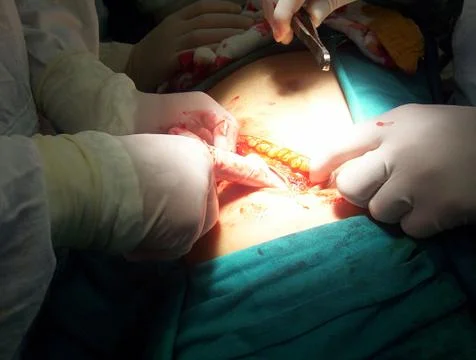 Splenectomy Stock Photos