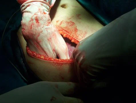 Splenectomy Stock Photos