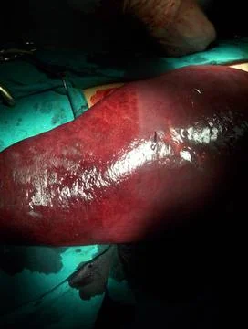 Splenectomy Stock Photos