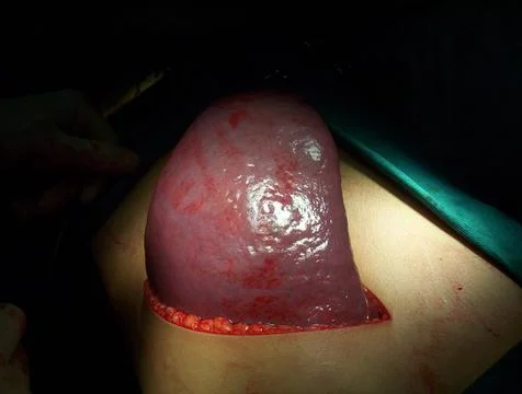 Splenectomy Stock Photos