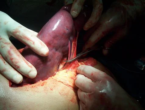 Splenectomy Stock Photos