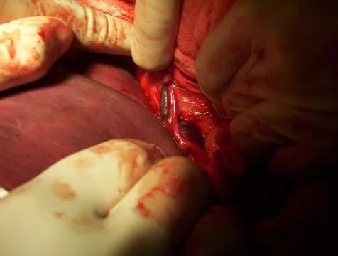 Splenectomy Stock Photos