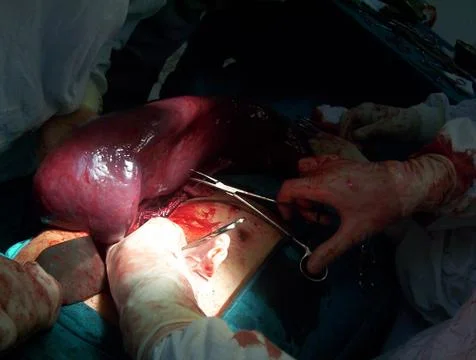 Splenectomy Stock Photos