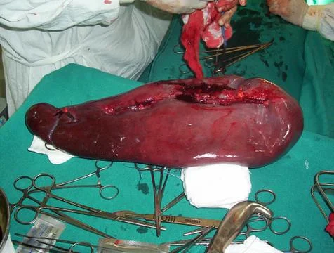 Splenectomy Stock Photos