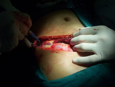 Splenectomy Stock Photos