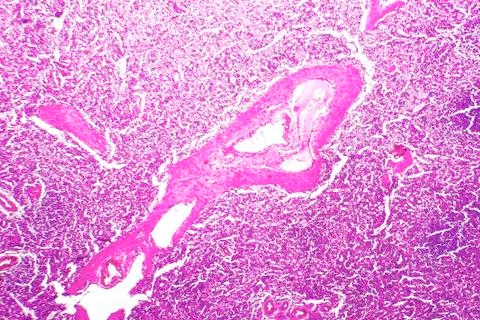 Splenic arterioles hyalinization Stock Photos