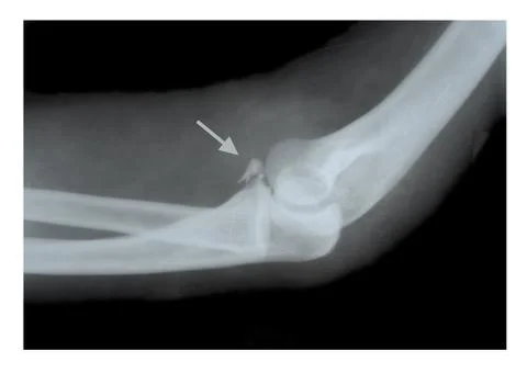 Splinter in forearm Stock Photos